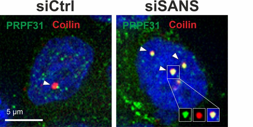 In the absence or dysregulation of SANS (siSANS), in contrast to a control (siCTRL), tri-snRNA complexes are not released from the Cajal bodies (coilin, red) but rather accumulate there (tri-snRNA component PRPF31, green). (ill./©: Uwe Wolfrum, Adem Yildirim)